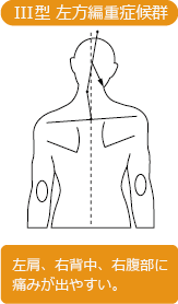 III型 左方編重症候群 左肩、右背中、右腹部に痛みが出やすい。